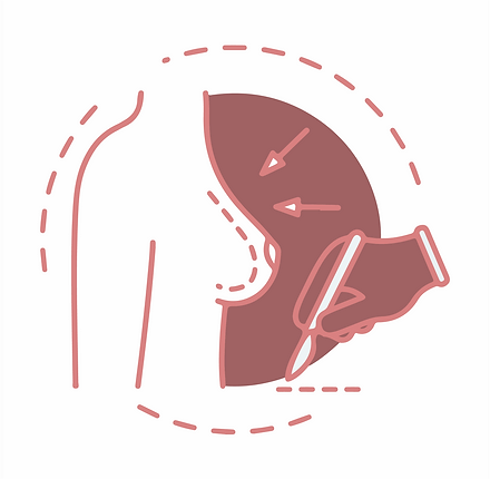 Breast reduction 300x