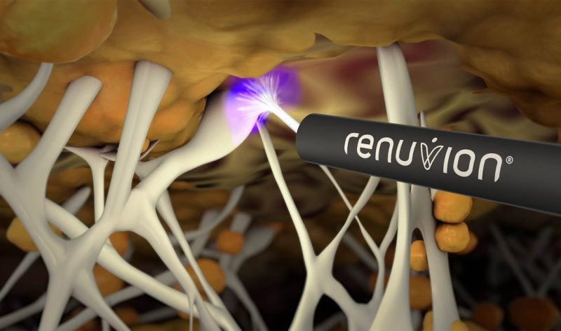 renuvion heating illustration logo w reg mark 2 300dpijpg 1920×1080 q85 subsampling 2.jpg 1100×650 q85 autocrop crop replace alpha fff subsampling 2 upscale Body Lifting