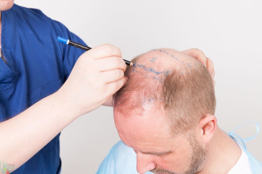 The Pros and Cons of Different Hair Replacement Methods