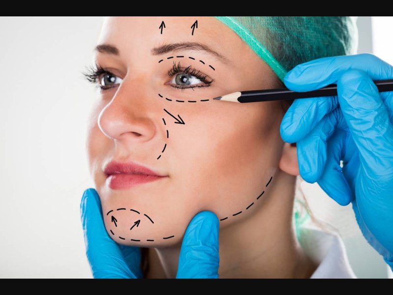 Facelift Surgery