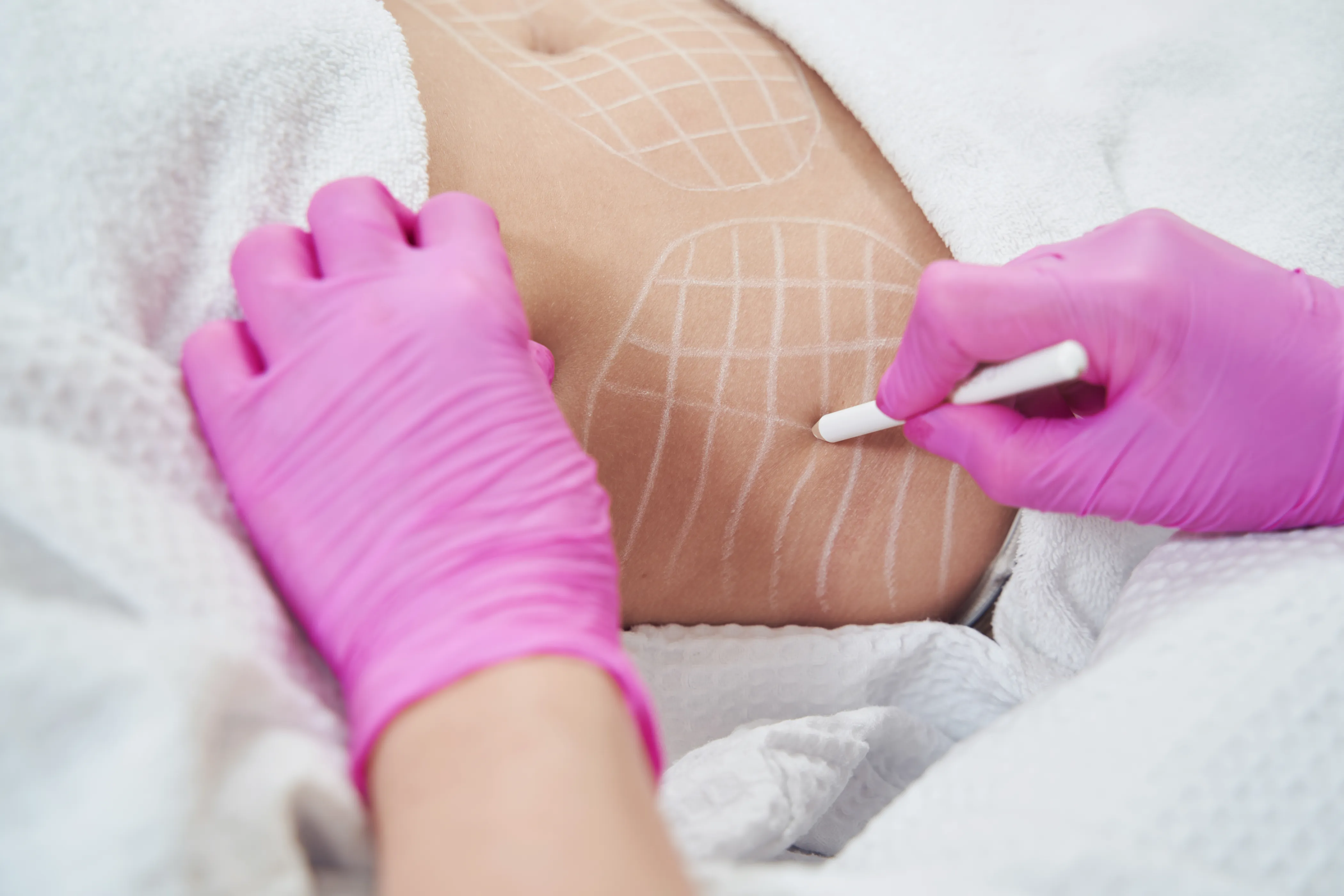 Fat Removal