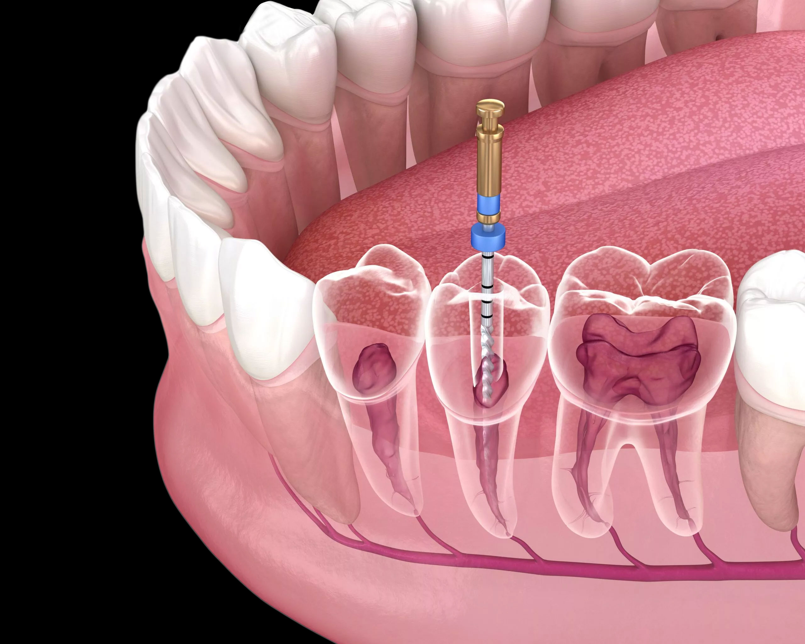 Root canal treatment