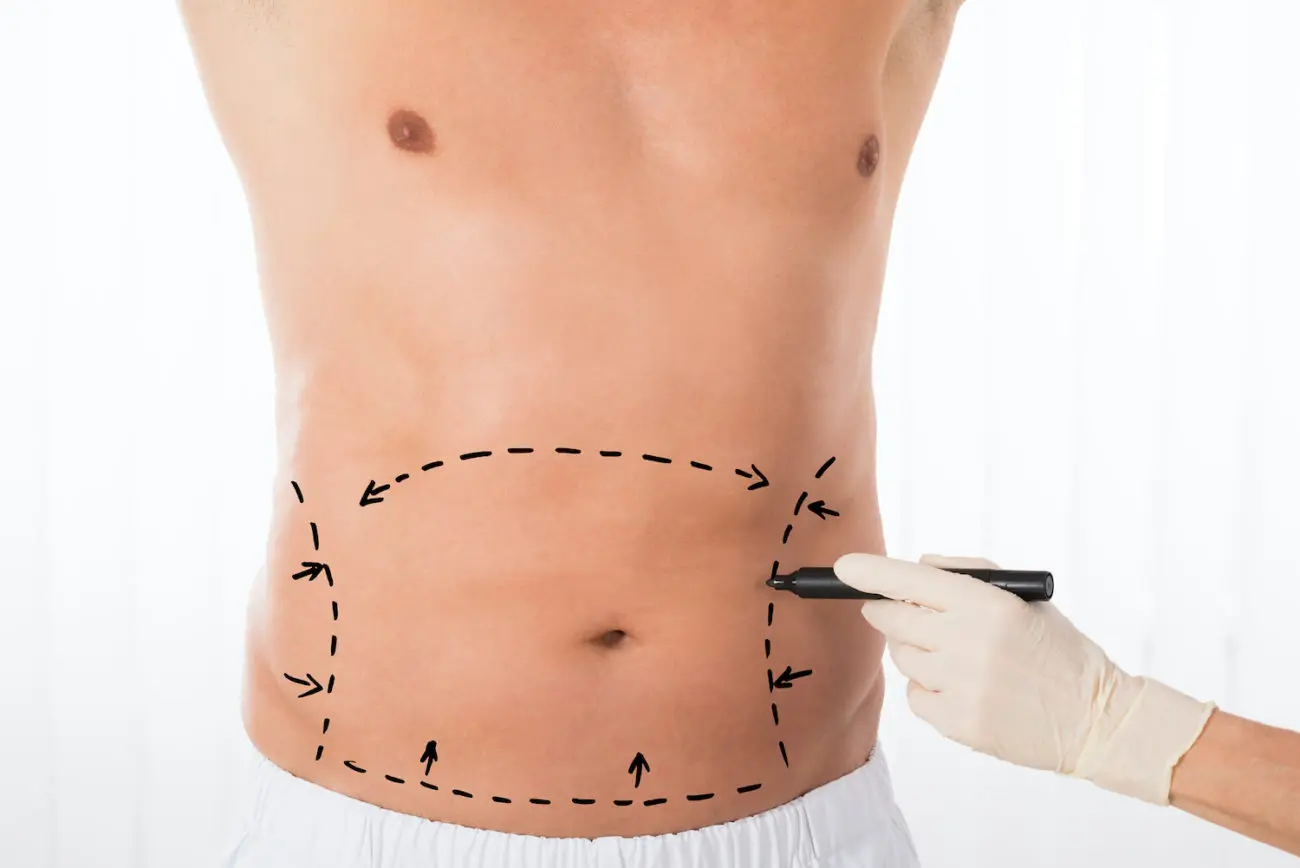 Smartlipo