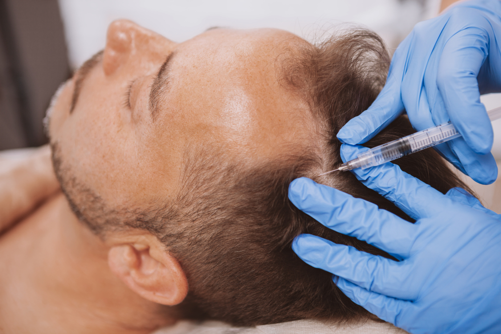 Stem Cell Hair Transplant