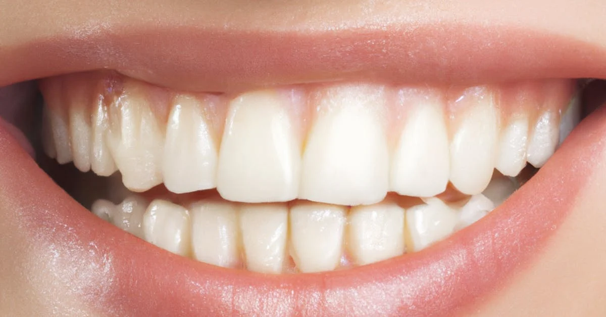 cost for smile makeover
