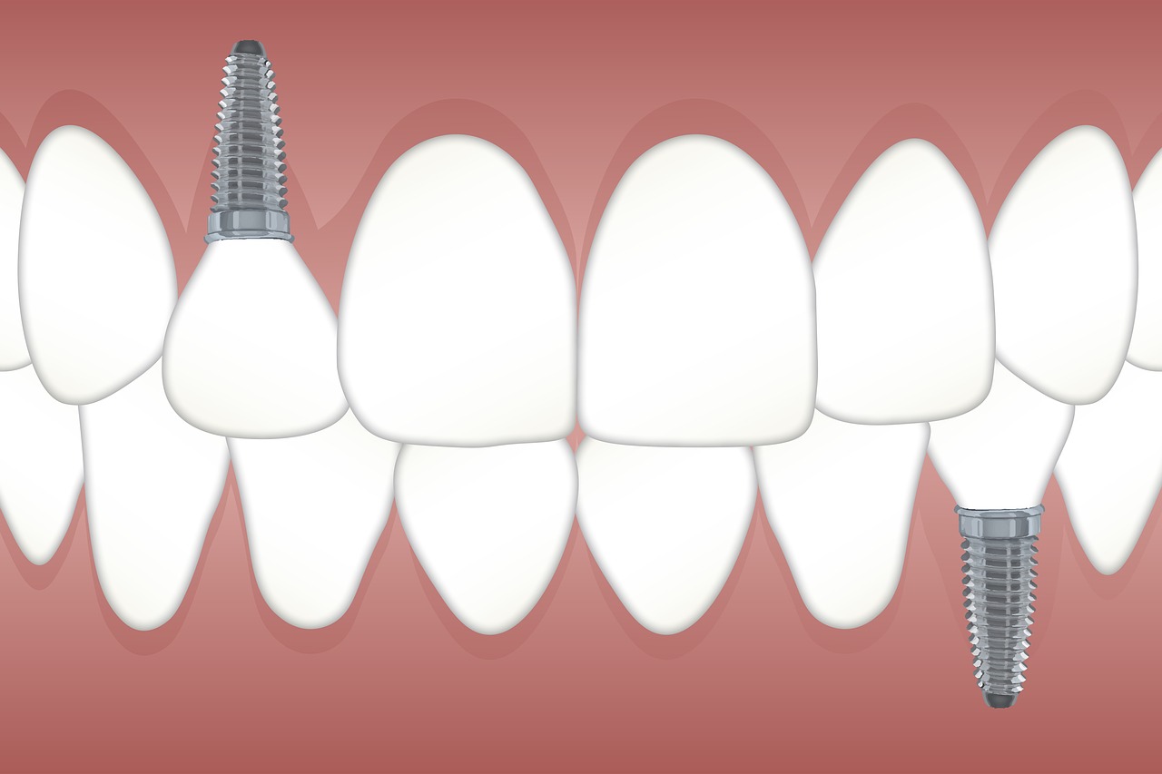 dental implants smile makeover