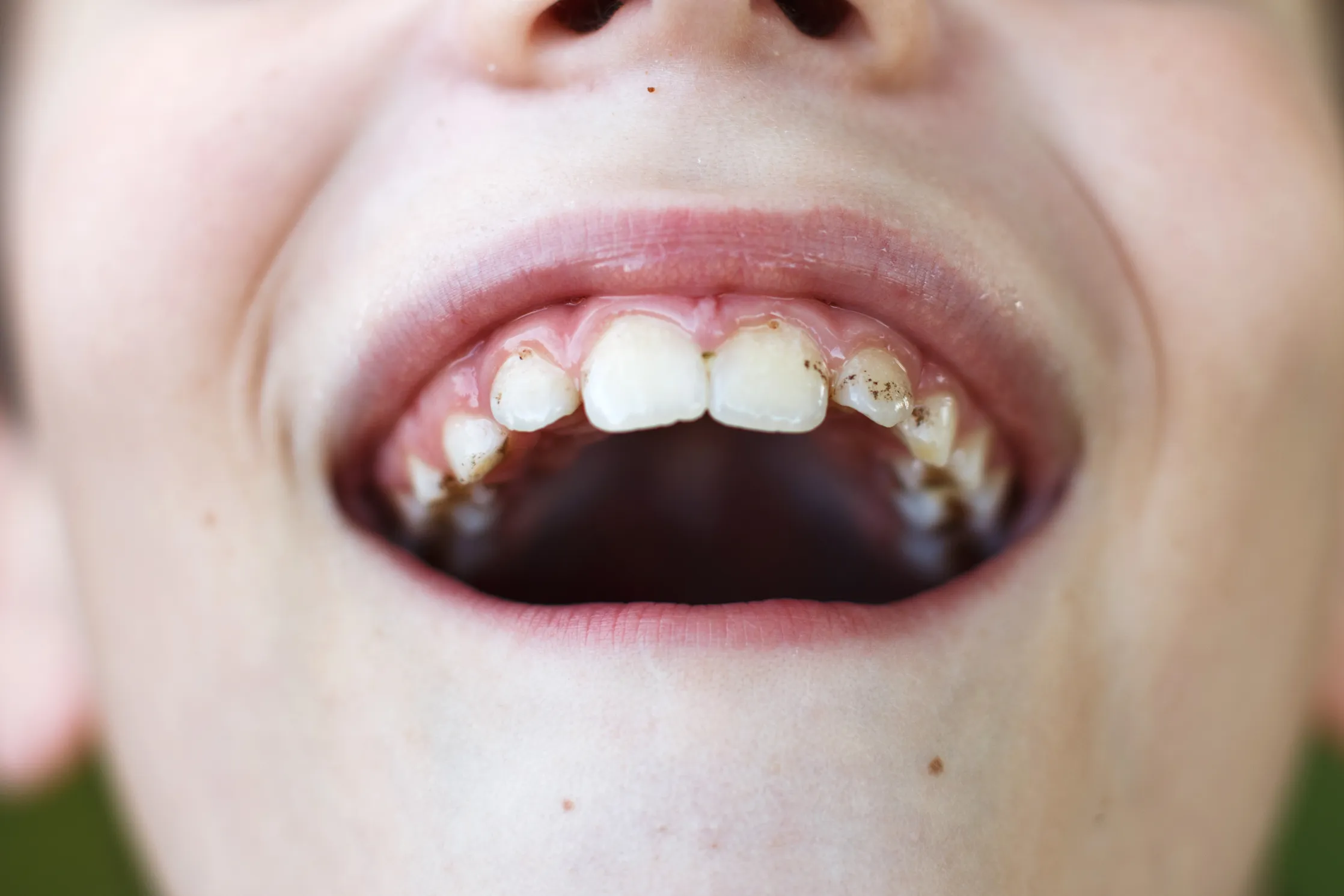 dental plaque