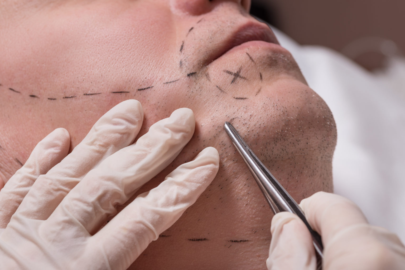Man,Beauty,Procedure,Beard,Hair,Implant,For,Senior,Man