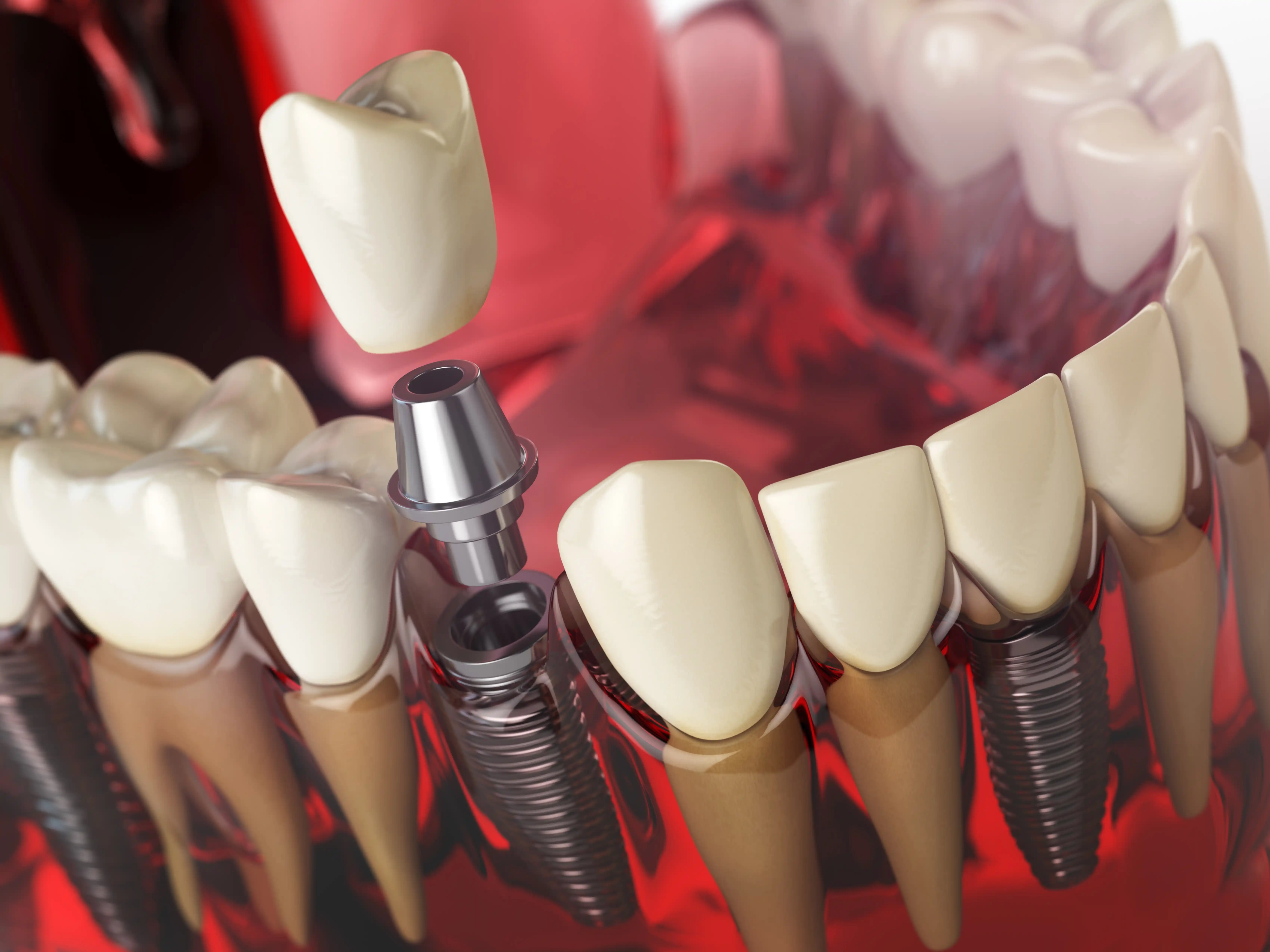 gum teeth scaled
