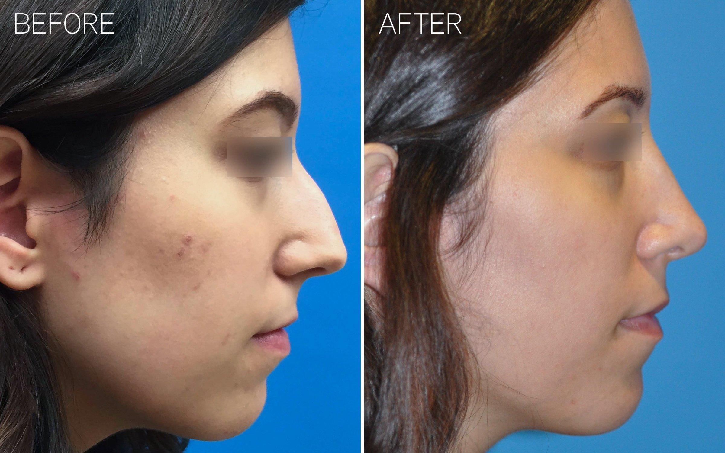 Rhinoplasty, Nose Job