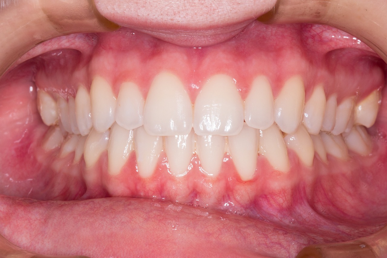 small teeth makeover