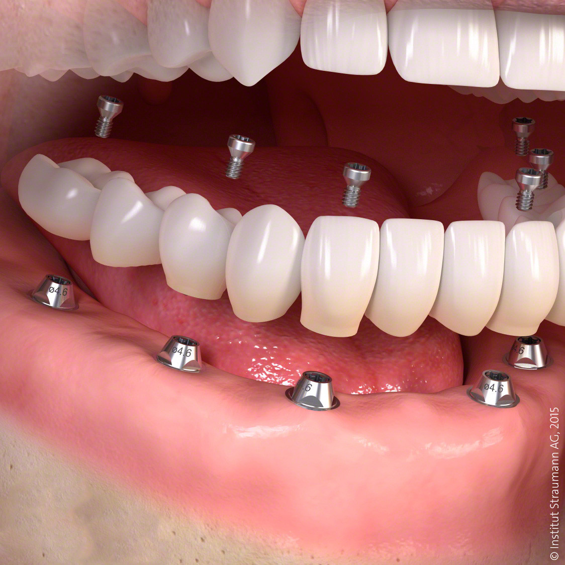 straumann implant