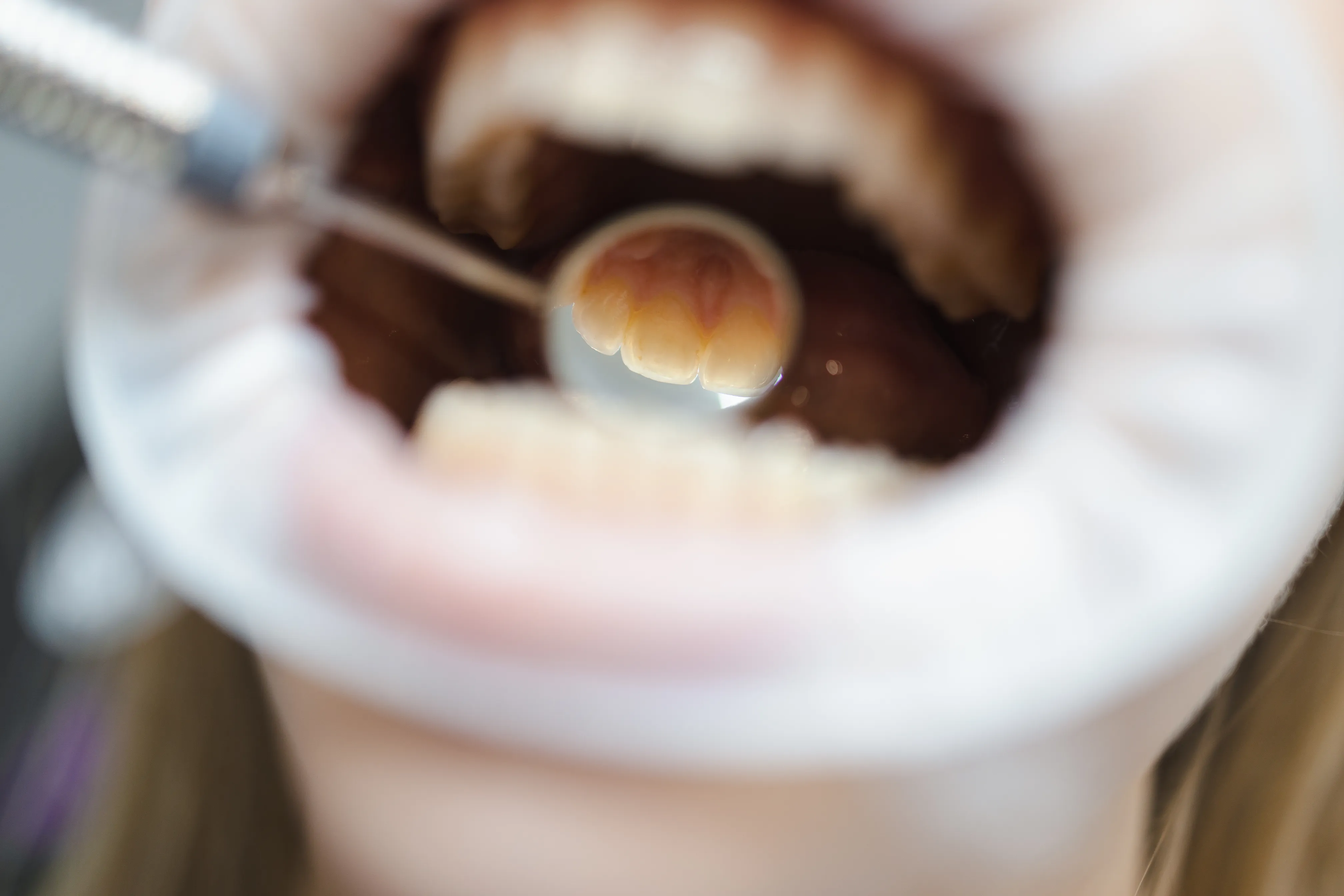 tartar teeth