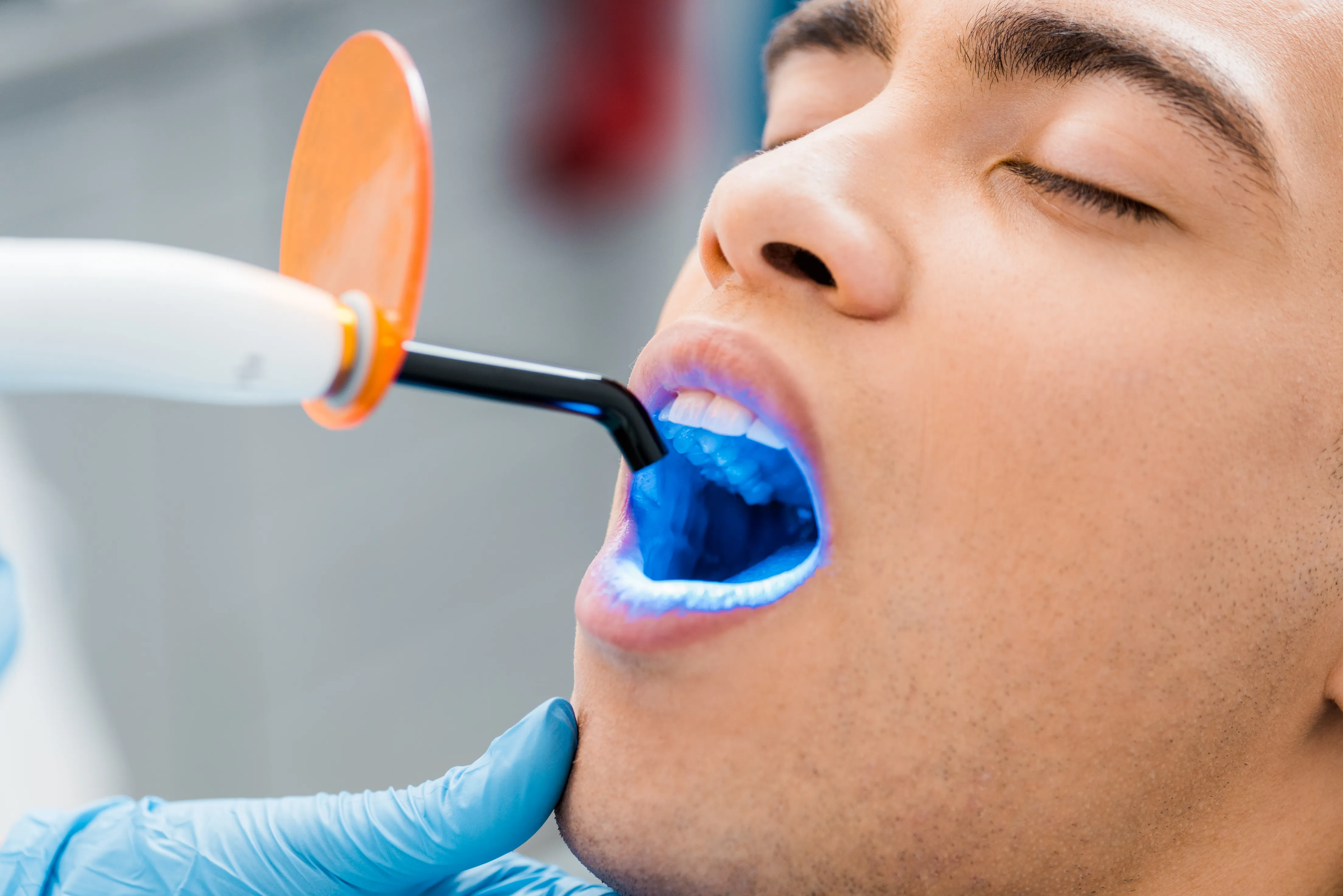 teeth bleaching